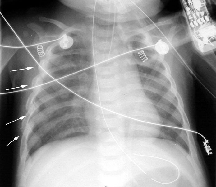 Rib films: multiple posterior rib fractures with callus