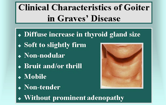 graves disease goiter