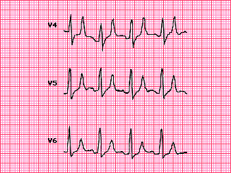 peaked t waves