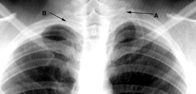 Dark lung fields