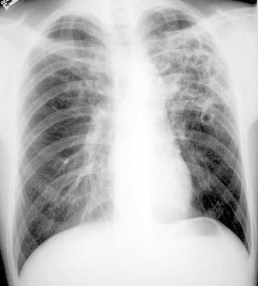 LUL cavities RUL infiltrate Bilateral upper lobe disease