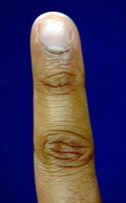 Fish Clubbing Method Physical Diagnosis-Clubbing