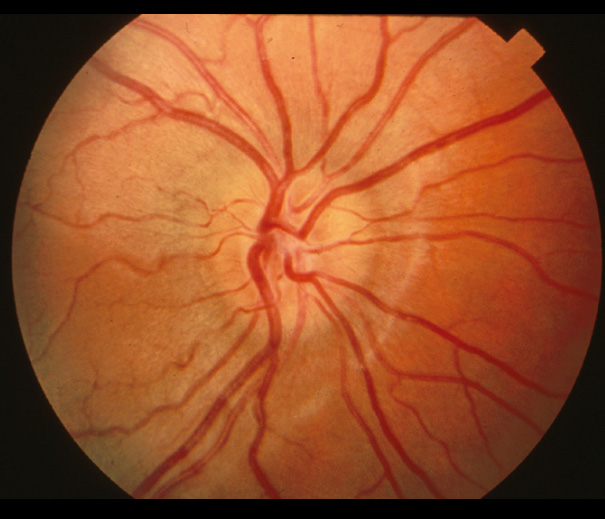 Normal Images of normal provided by Dr Cronin, MD