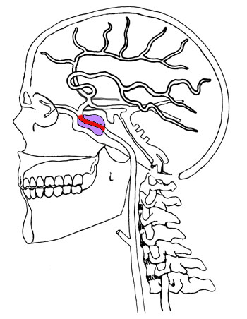 Cervical Carotid