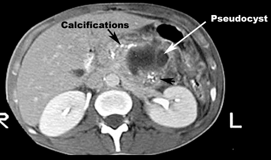 normal pancreas cat scan