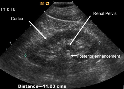 kidney ultrasound tumor