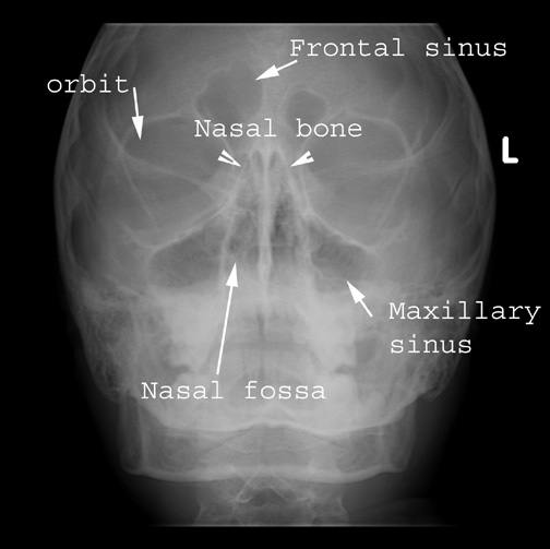 Identify the sinuses. Click the image for labeling.