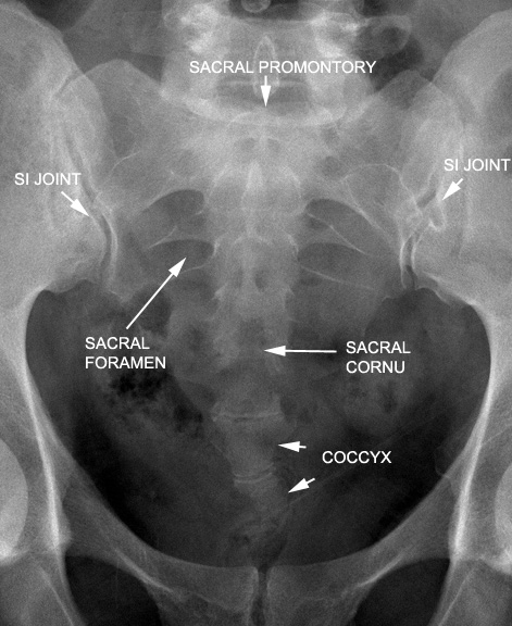 identify parts of the sacrum click the image for labeling