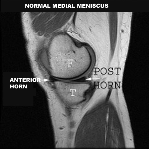 identify parts of the medial meniscus click the image for labeling