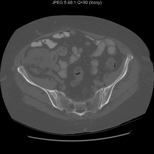 Identify the sacroiliac joint. Click the image for labeling.