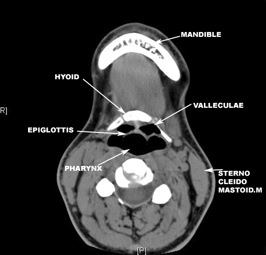 identify the pharynx valleculae epiglottis hyoid and mandible click the ...