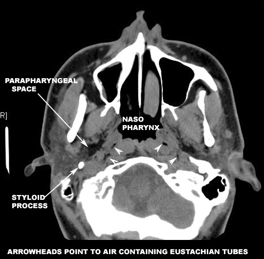 identify the parapharyngeal space click the image for labeling