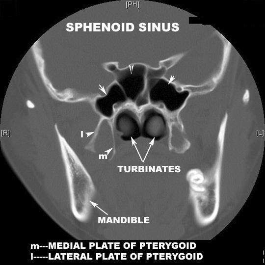 identify the mandible and pterygoids click the image for labeling