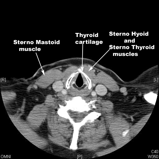 identify thyroid sternomastoid and stenohyoid muscles