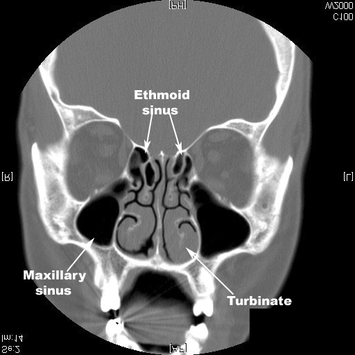 identify sphenoid and maxillary sinus