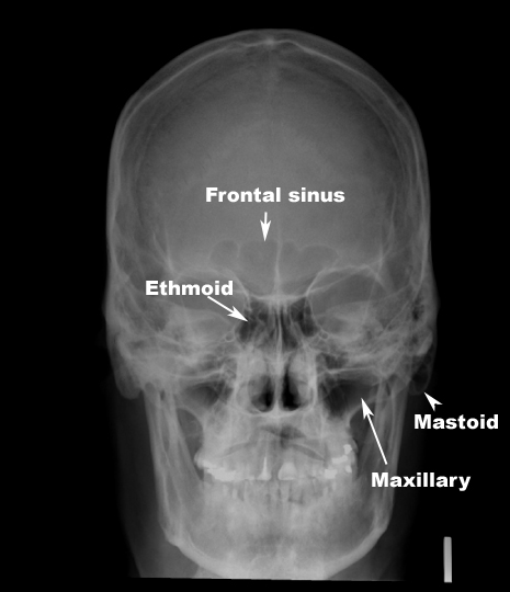 Identify The Sinuses You See Click On The Image To See The Labeled Image