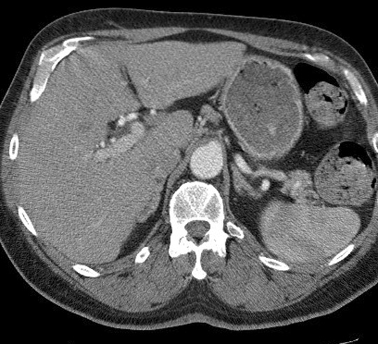 Course of Esophagus