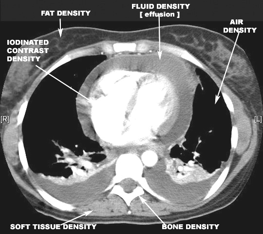 Identify the densities in the CT. Click the image for labeling.