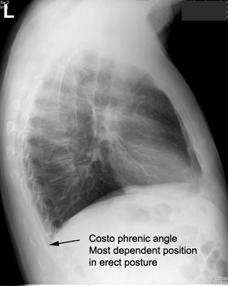 Identify the costodiaphragmatic angle. How do we use this information ...