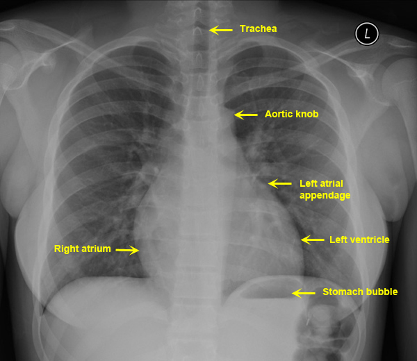 normal chest x ray labeled